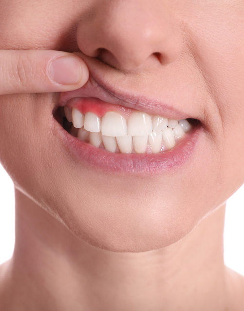 Periodontal Disease